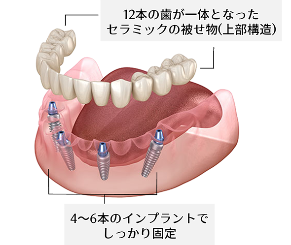 【12本の歯が一体となったセラミックの被せ物（上部構造）】【4～6本のインプラントでしっかり固定】