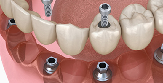片顎4本～6本のインプラントで全体の歯を支える