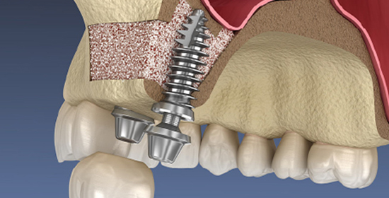 骨造成が不要なケースも多い