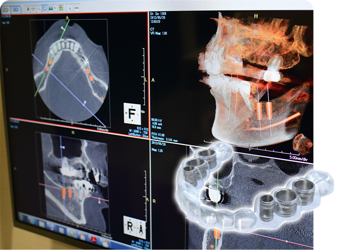 サージカルガイドとは