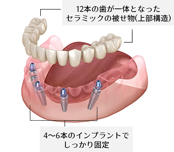 【12本の歯が一体となったセラミックの被せ物（上部構造）】【4～6本のインプラントでしっかり固定】