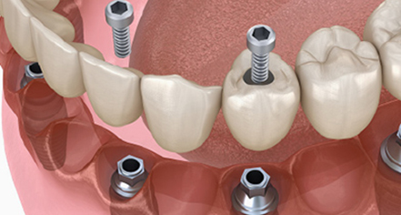 片顎4本～6本のインプラントで全体の歯を支える