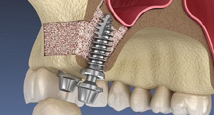 骨造成が不要なケースも多い