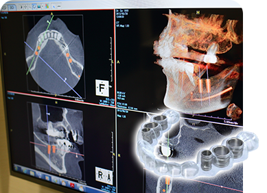 サージカルガイドとは