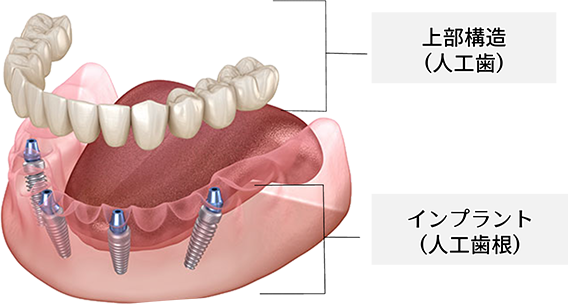【上部構造（人口歯）】【インプラント（人工歯根）】