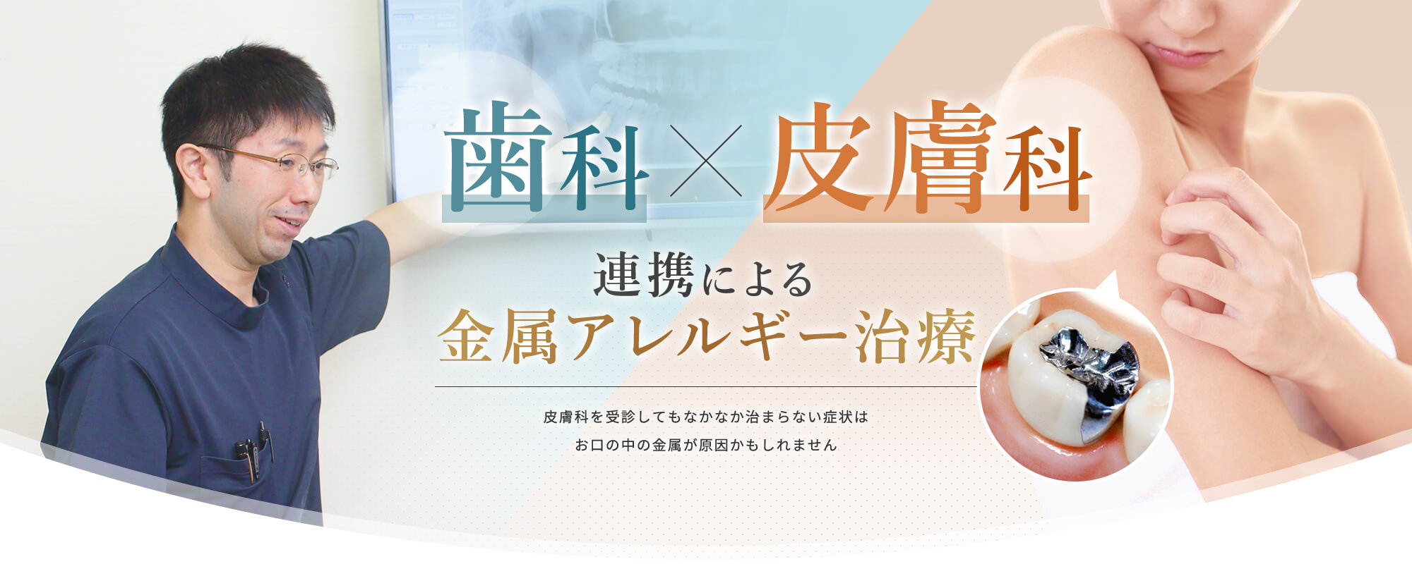 歯科×皮膚科 連携による金属アレルギー治療 皮膚科を受診してもなかなか治まらない症状はお口の中の金属が原因かもしれません