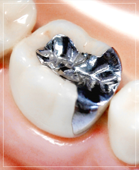 歯科金属アレルギーとはお口の中に入っている金属が原因で引き起こされます
