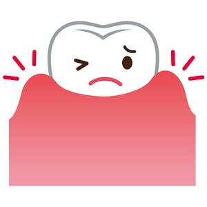 インプラント歯周炎の原因