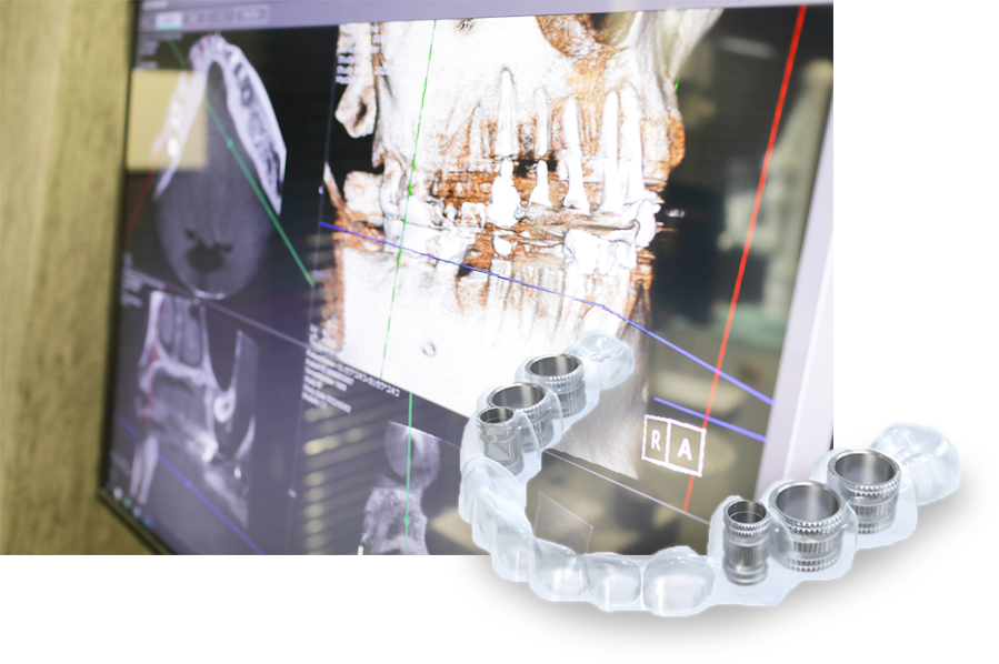 デジタル技術を活用した安全で精度の高いインプラント治療