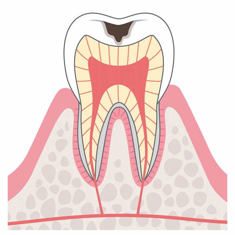 C2：象牙質まで進んだむし歯