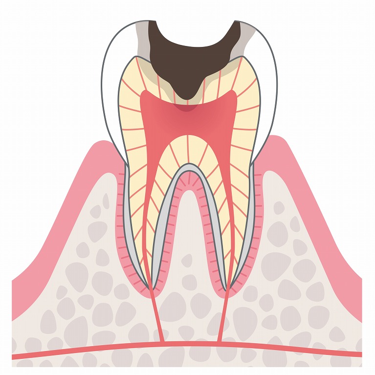 C3：歯髄まで進んだむし歯