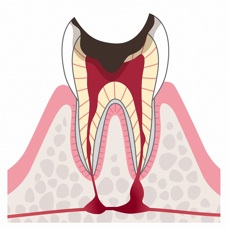 C4：歯根だけ残ったむし歯