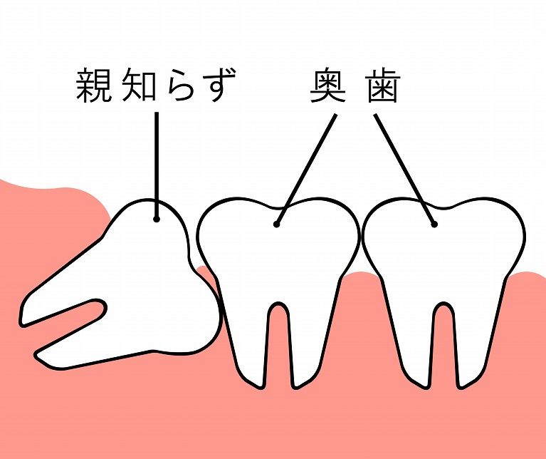 抜歯 痛み 親知らず 親知らずの抜歯後、一週間たっても痛みがある場合の対処法